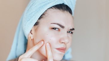 Acne e brufoli