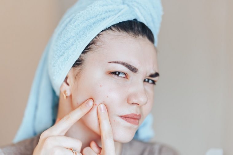 Acne e brufoli