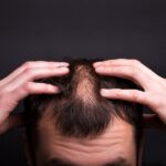 alopecia areata