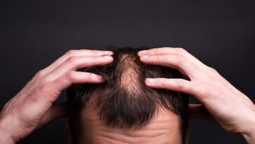 alopecia areata