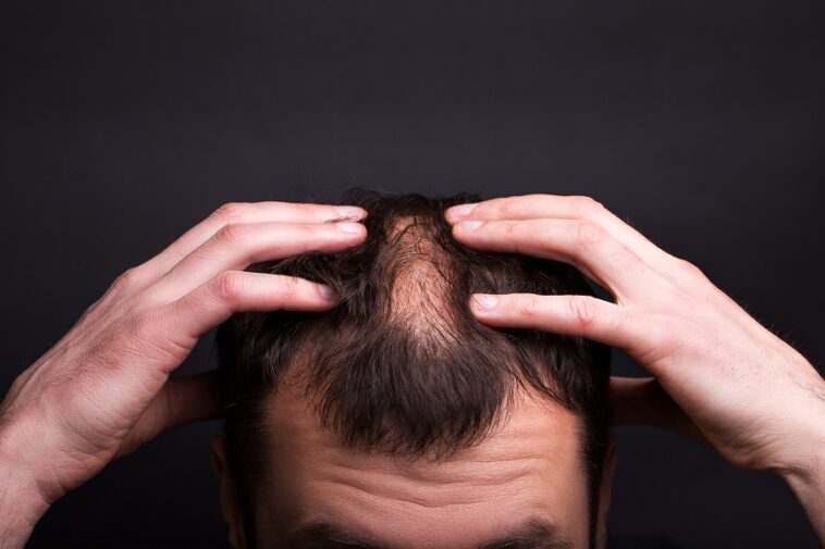 alopecia areata